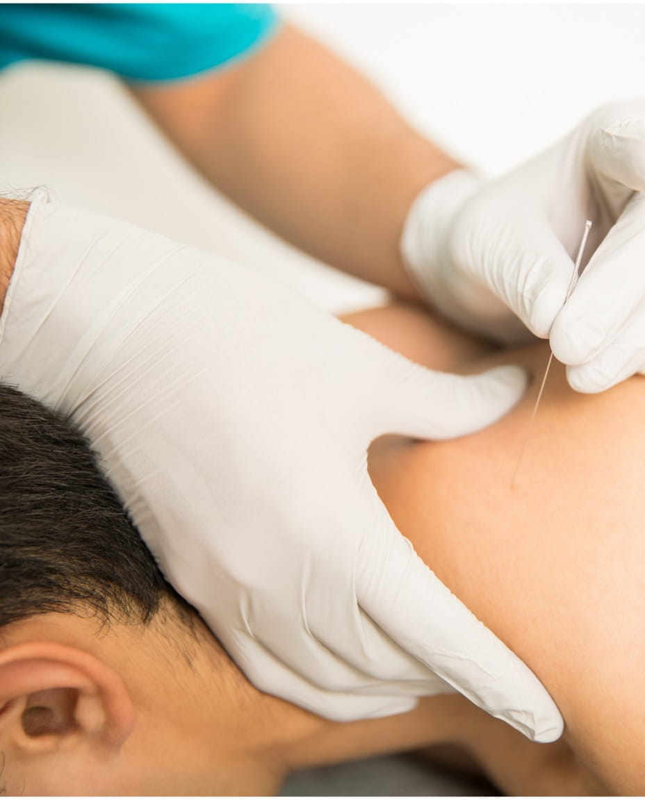 Physiotherapist performing dry needling on muscle trigger points